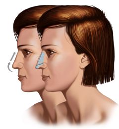 Operacja plastyczna nosa